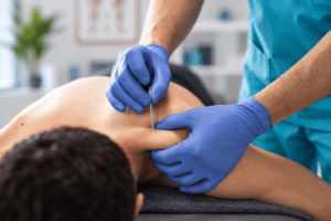 Punción seca en fisioterapia en Alcobendas en AlcoFisio